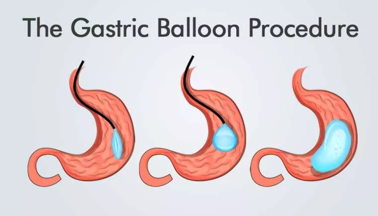 Is Getting a Gastric Balloon Worth It?